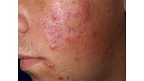 How To Remove Dark Spots Caused By Pimples Change Comin