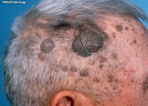 Skin Cancer Lesions On Face Tinea Corporis Ringworm Tinea Circinata