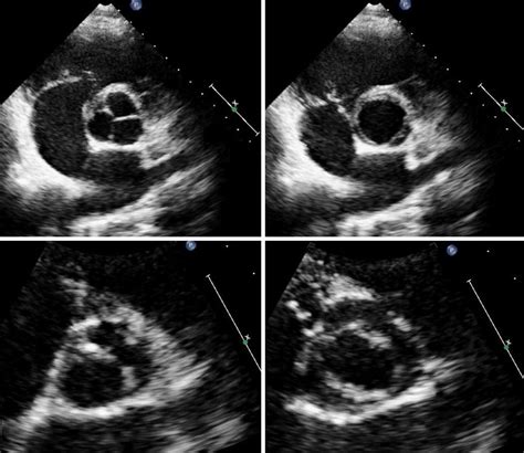 The Parasternal Short Axis View On The Aortic Valve At Two Dimensional Download Scientific