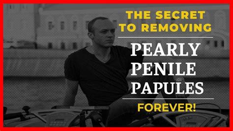How To Get Rid Of Pearly Penile Papules Home Remedy Worry No More