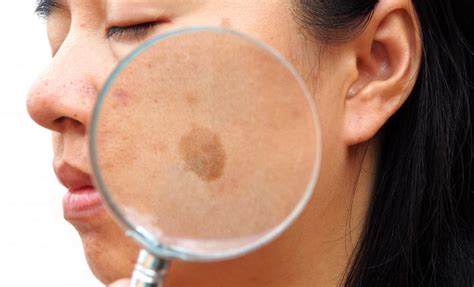 Seborrheic Keratosis Face