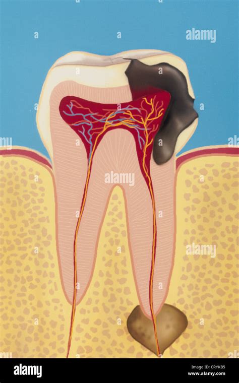 Dental Abscess Drawing Stock Photo Alamy