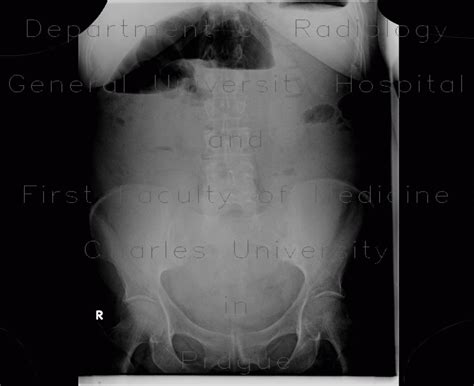 Radiology Case Carcinoma Of Sigmoid Colon Large Bowel Obstruction Ileus