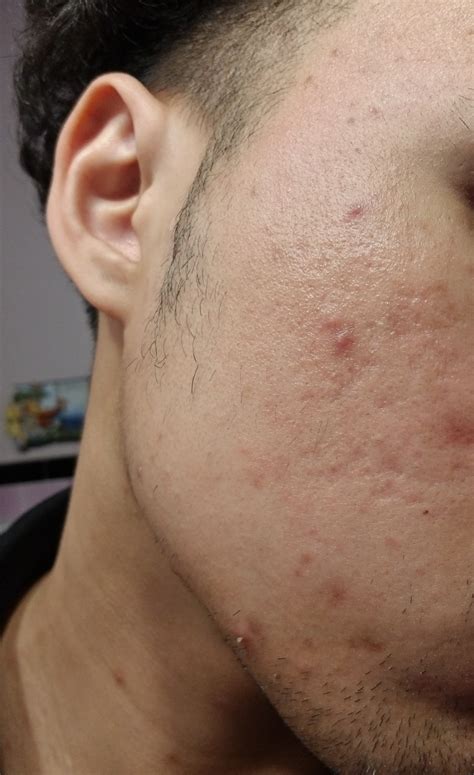 Can Someone Tell Me What Type Of Acne Scars Do I Have Scar