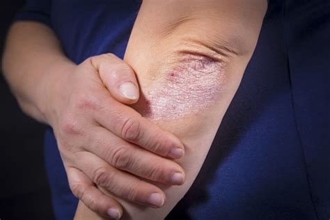 Common Psoriasis Symptoms Psoriasis Treatments