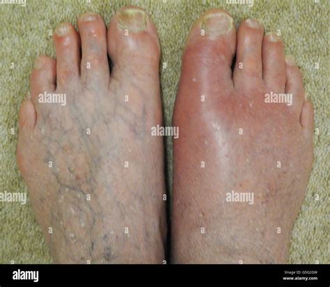 Gout Is A Type Of Arthritis Where Swelling And Severe Pain Develops In