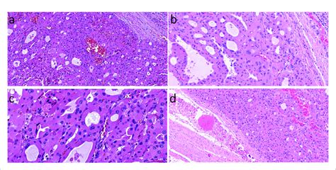 Oncocytic Follicular Patterned Differentiated Thyroid Carcinoma