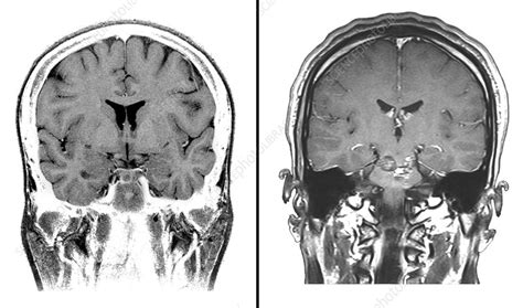 Mri Of Normal Brain And Ms Lesions Stock Image C0272389 Science
