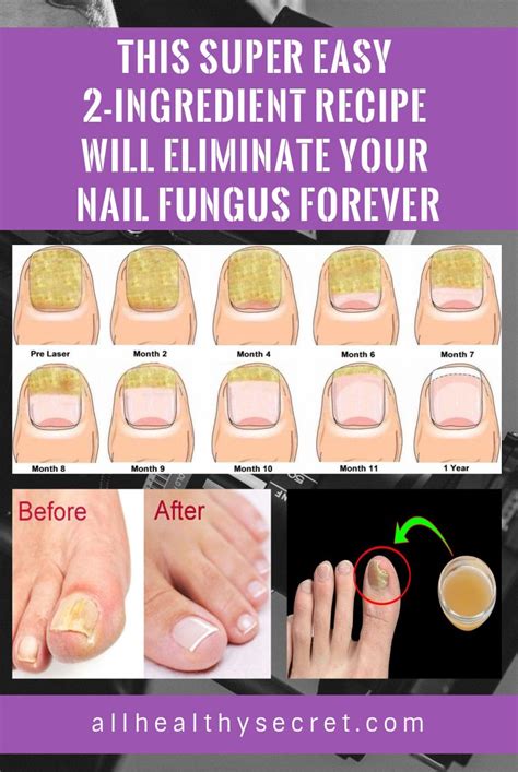 This Super Easy 2 Ingredient Recipe Will Eliminate Your Nail Fungus