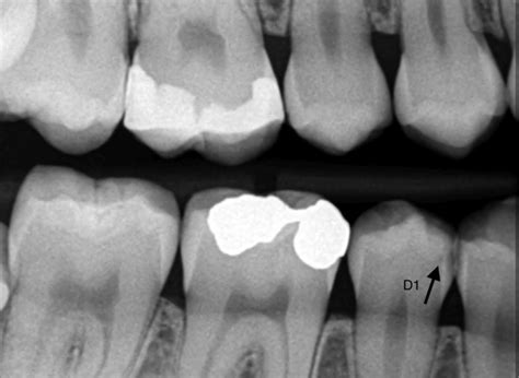 Diagnostico Por Imágenes De Las Lesiones Cariosas Interproximales