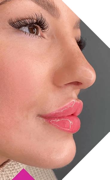 Russian Lips Russian Lip Technique Miracleface Medspa
