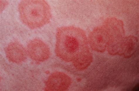 Erythema Multiforme Causes Types Symptoms Diagnosis And