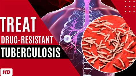 how to treat drug resistant tuberculosis youtube