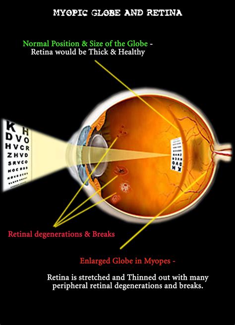 Myopia,Retinal Breaks,Retinal Detachment