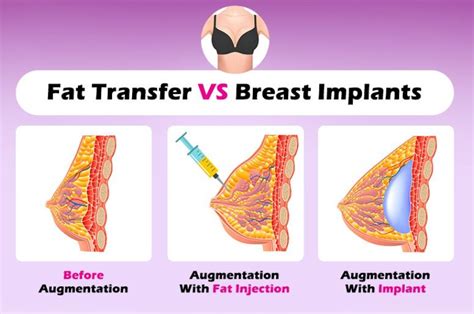 Breast Implants Versus Fat Transfer Pros And Con