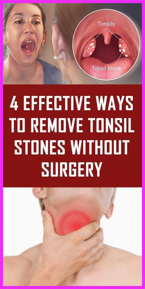 Tonsil Stones Can Easily Be Removed Without Surgery Health Medicine