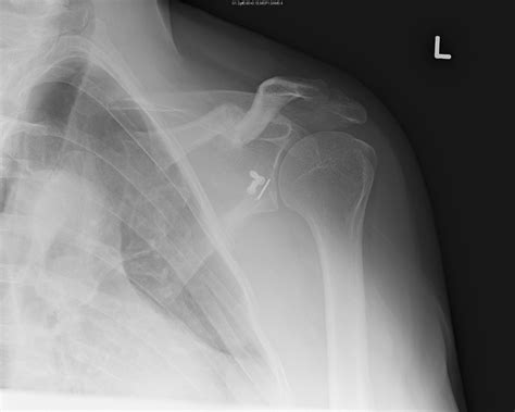 Fractures around the shoulder including glenoid, humeral ...