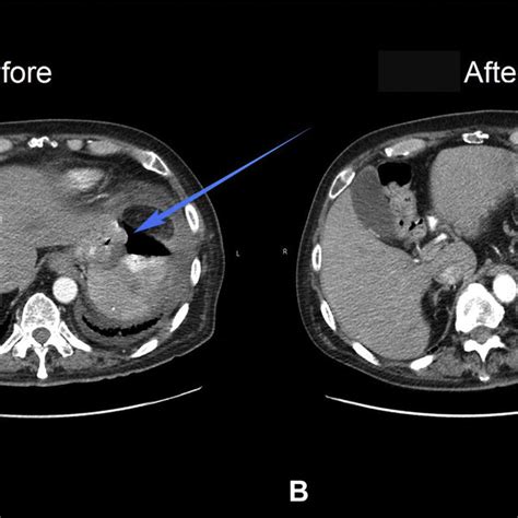 A Ct Scan Showing Retroperitoneal Mass And Air Suggestive Of A