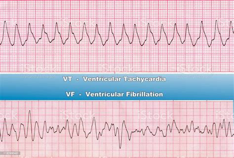 Ventricular Tachycardia Ventricular Fibrillation Stock Photo Download