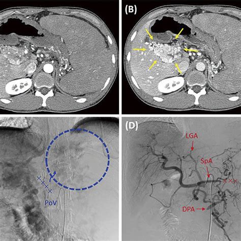 Figure2 Images Of Abdominal Computed Tomography CT A B And