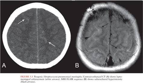 Imaging Of Intracranial Infections Approach To The Patient