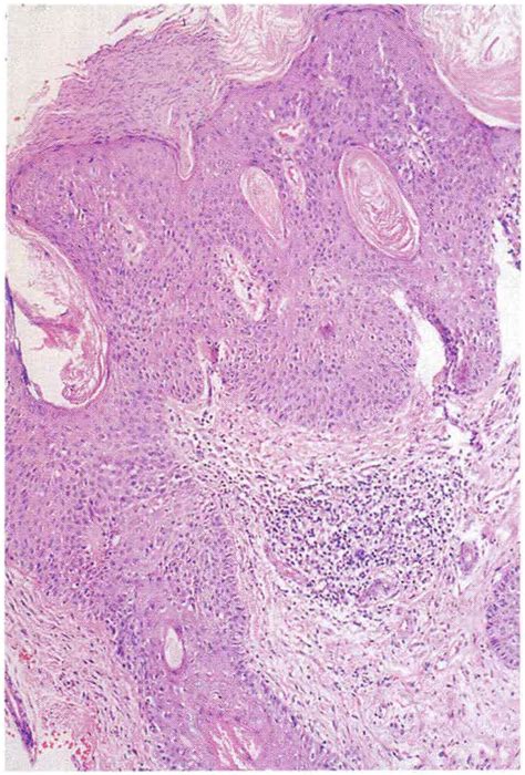 Carcinoma De Células Escamosas Cutáneo Parte Ii Histopatología Y