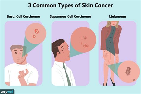 What Is Skin Cancer And What Are Different Types Of S Vrogue Co