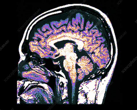 Mri Of Normal Brain Stock Image C0094718 Science Photo Library