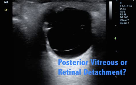 Hennepin Ultrasound Vitreous Vs Retinal Detachment