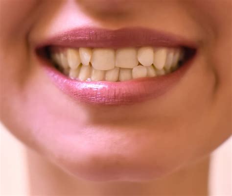 Malocclusione Dentale Cos Sintomi Cause E Cura