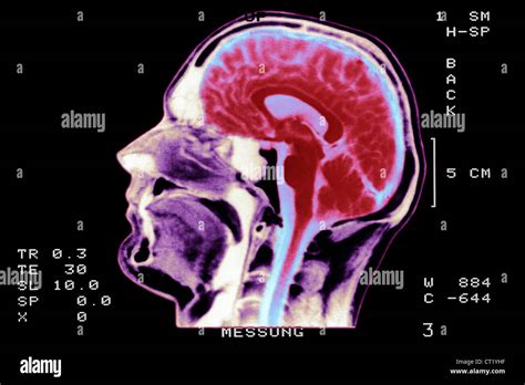 Normal Brain Scan Hi Res Stock Photography And Images Alamy