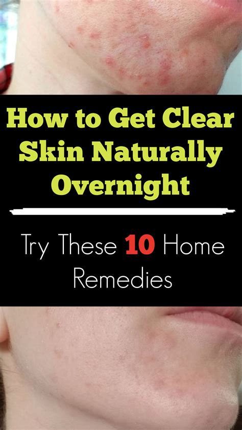 How To Get Clear Skin Naturally Overnight Try These 10 Home Remedies