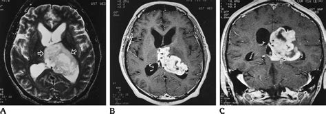 Case 2 46 Year Old Man With Diplopia And Occipital Headache A Axial