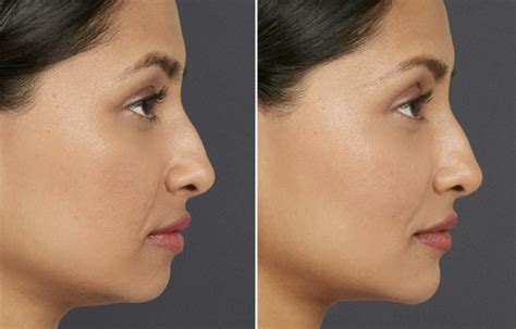 Recessed Chin Allura Skin Laser And Wellness Clinic Fort Collins