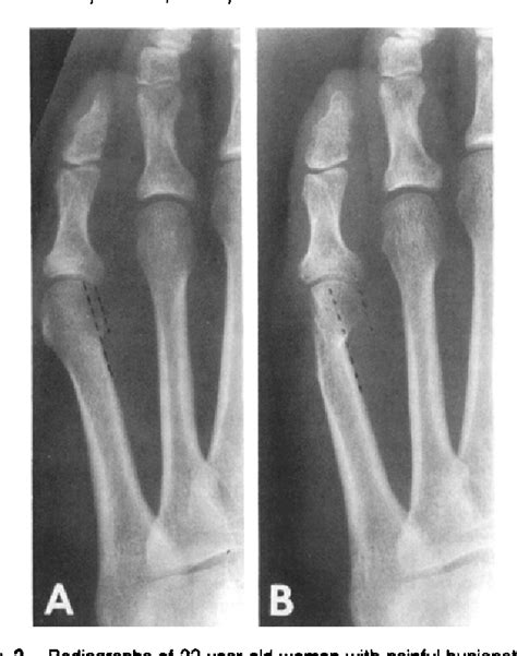 Figure 2 From Distal Chevron Metatarsal Osteotomy For Bunionette