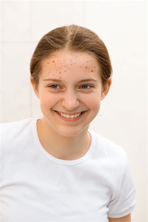 cara de una adolescente con acné de granos sobre el concepto cutáneo de belleza y salud foto de