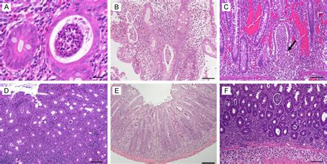 Crypt Abscesses Representative Images Of Hande Stained Colon Sections