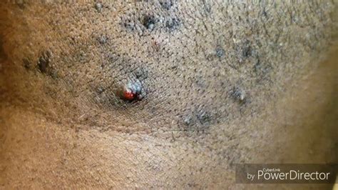 Ingrown Hair In Scalp Bumps Bumps At The Back Of The Head Keloids