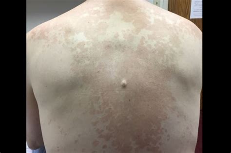 Derm Dx Extensive Rash On The Chest And Back Clinical Advisor
