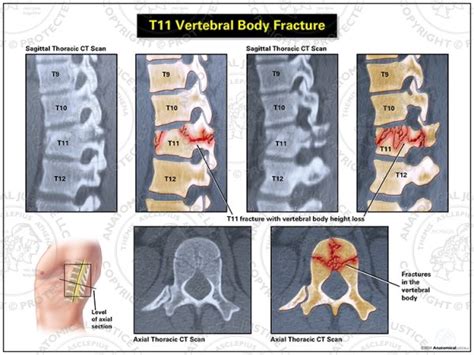 T11 Vertebral Body Fracture