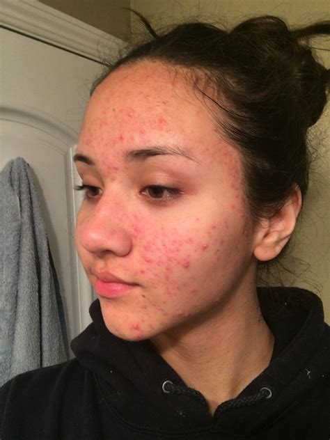 B A One Year After Accutane Girl With Acne Acne Makeup Real Beauty