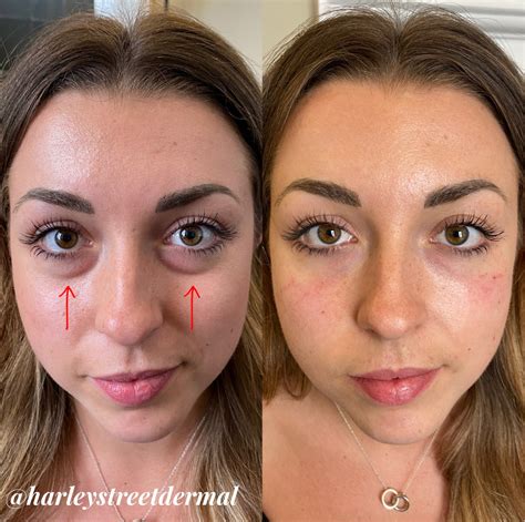 Dark Circles Treatment In London Harley Street Dermal