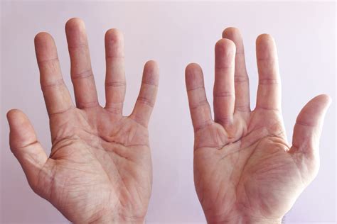 Trigger Finger Vs Dupuytrens Contracture Banner Health