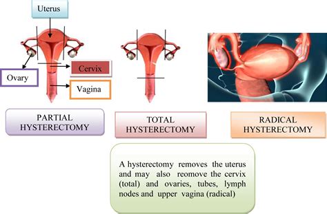 Uterus Radical Hysterectomy Beautiful Cervix Project