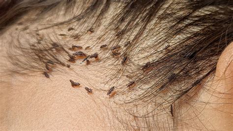 Plucking Out All Lice From Her Long Hair Remove Thousand Lice From