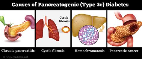 Type 3c Pancreatogenic Diabetes Causes Symptoms Diagnosis