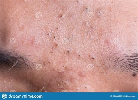 Ugly Pimples Acne Zit And Blackheads On The Cheek Of A Teenager Stock