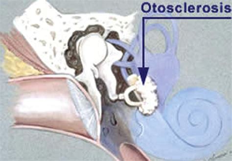 Otosclerosis Types Causes Symptoms Treatment And Prognosis