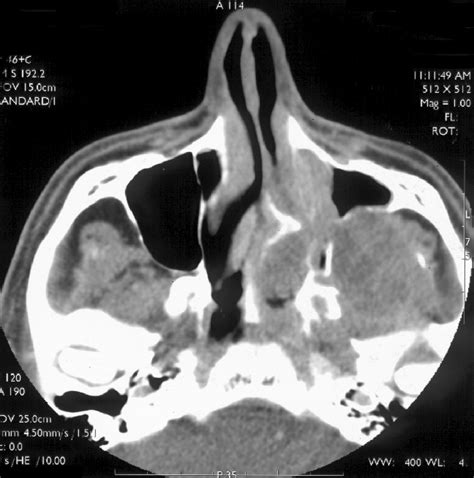 Axial CT Post Contrast Soft Tissue Windows In A Patient With Adenoid