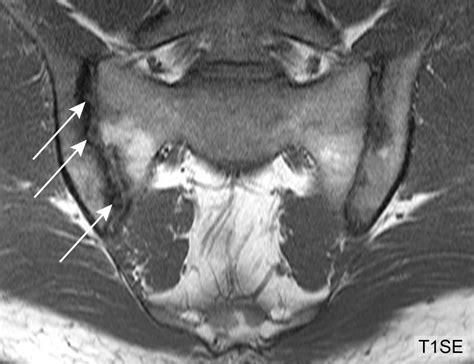 Can Erosions On Mri Of The Sacroiliac Joints Be Reliably Detected In